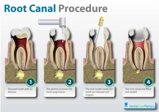 Root Canals 2