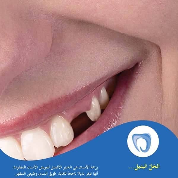 Dental Implants 2