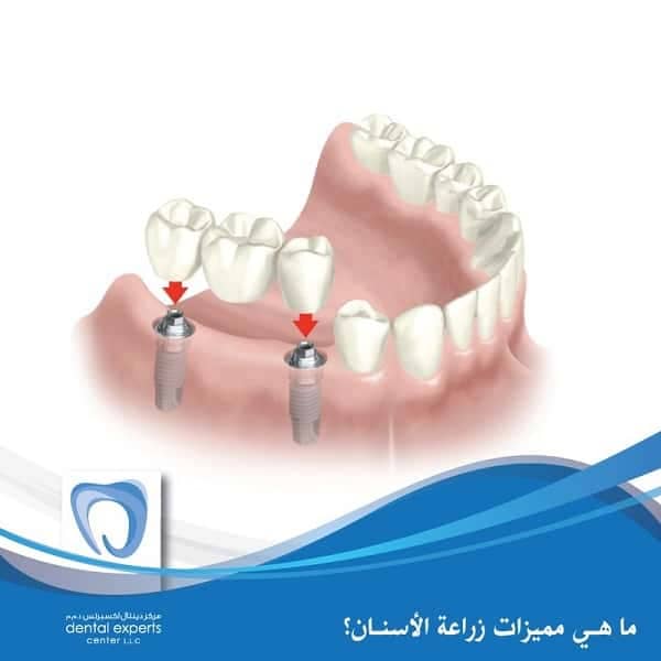 Dental Implants 4