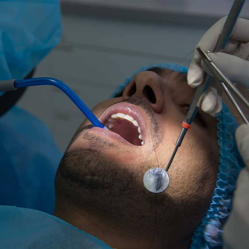 Tooth Extraction 02